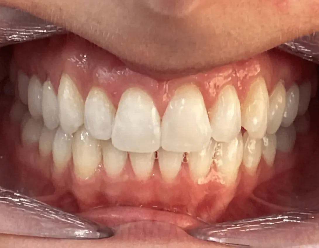 Invisalign with composite veneers after photo
