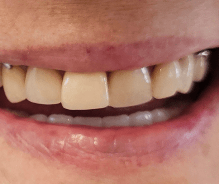 After dental implants treatment - restored smile with natural-looking tooth implant in Norfolk