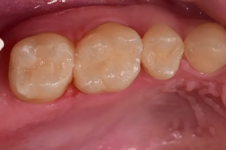 After treatment photo