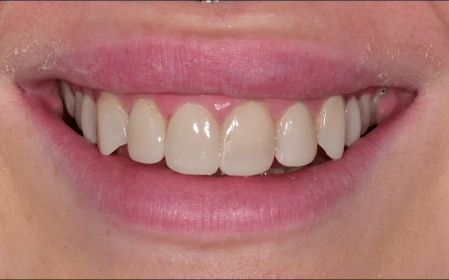 After treatment photo