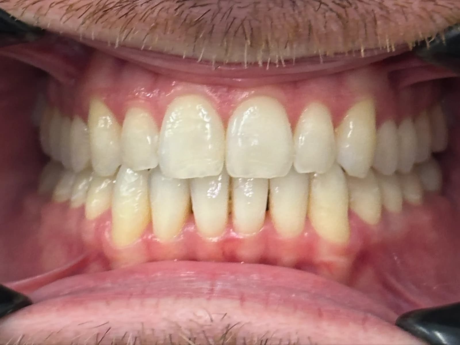 Close-up of straight, aligned teeth after Invisalign and composite veneers