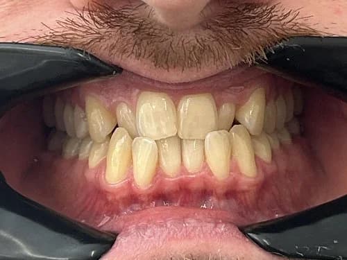 Close-up of crowded and misaligned teeth before Invisalign treatment