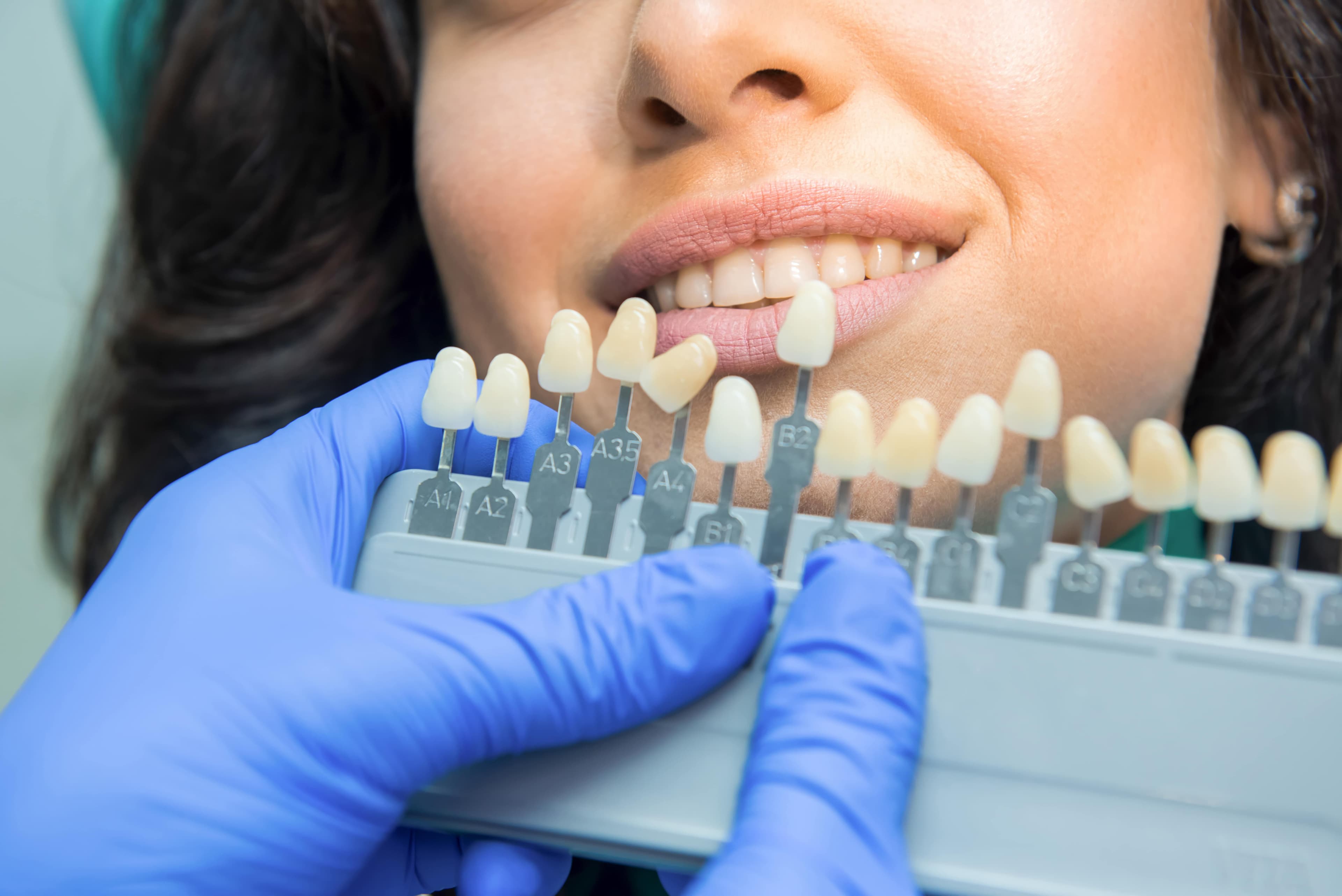 Professional teeth whitening at Taverham Dental preview image