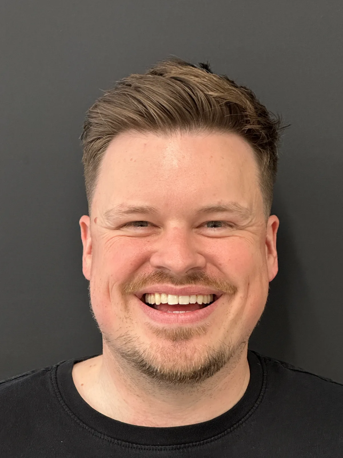 Patient smile after Invisalign and composite veneers